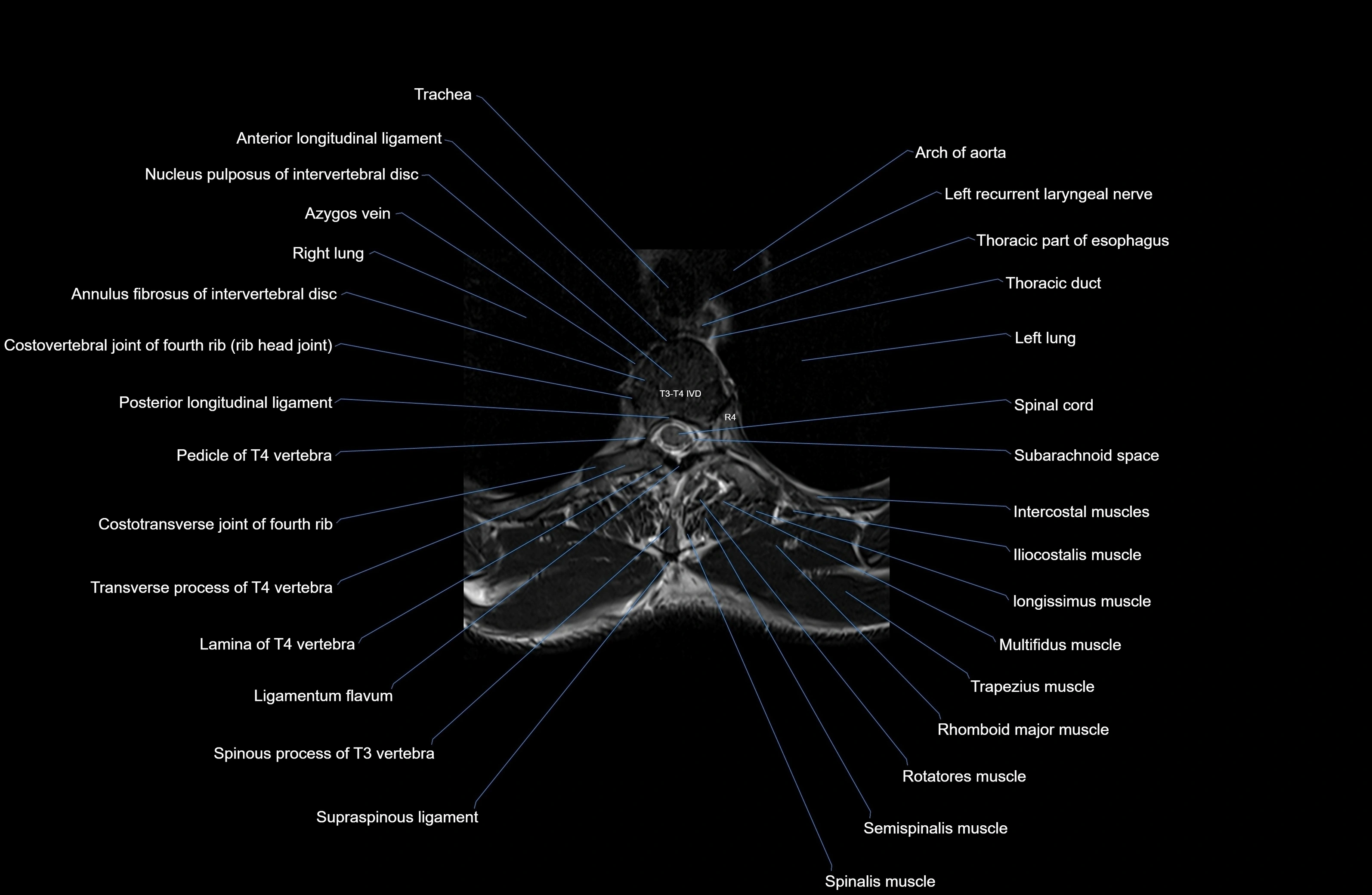 MRI thoracic spine axial  cross sectional anatomy 3T radiology  image-img-00001-00024.webp